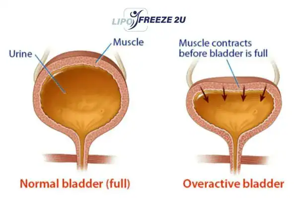 diagram of overactive bladder treatment Wigston
