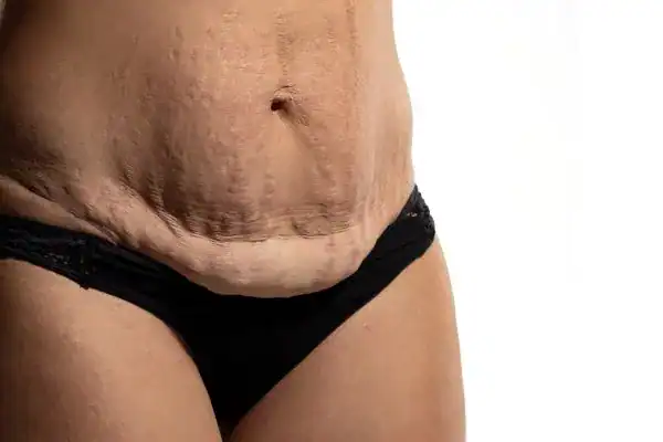 loose skin after weight loss injections Wigston