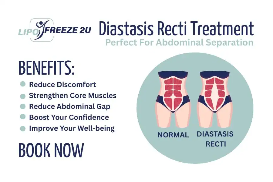 How Long Will It Take to See Improvements in Diastasis Recti Wigston