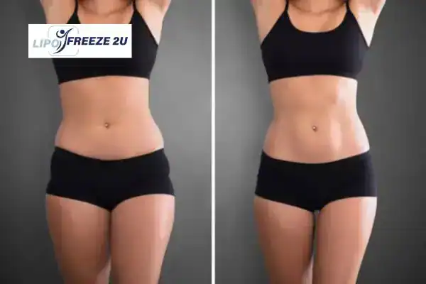 How Can LIPO FREEZE 2U Support Your Post-Pregnancy Body Recovery Wigston?