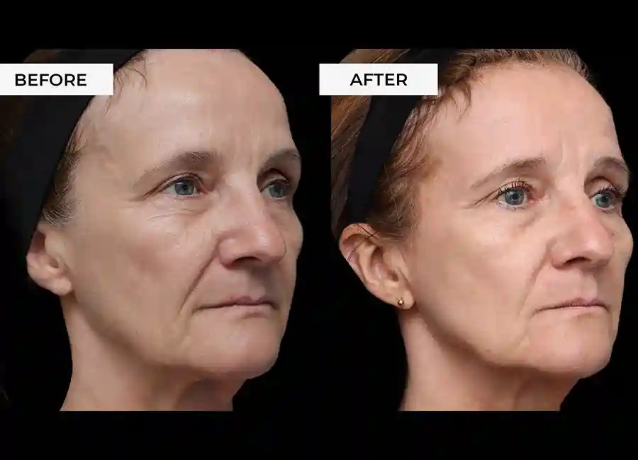 How Many RF Microneedling Sessions Will You Need to See a Difference Wigston?